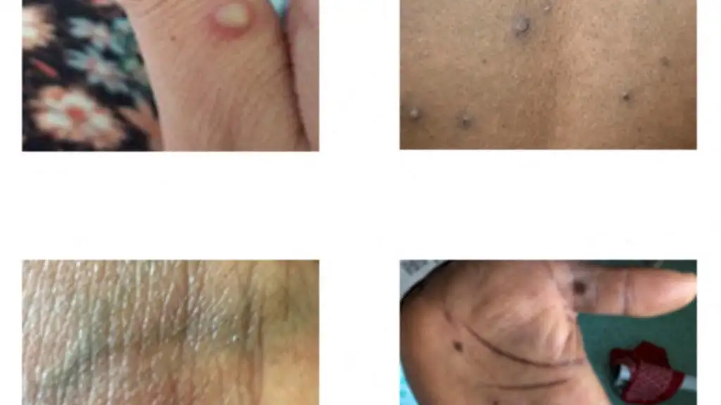 Les virologues de la Cédéao se réunissent pour se préparer à la variole du singe