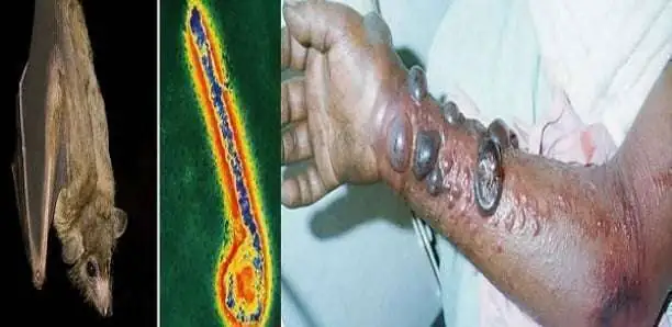 Guinée équatoriale : 2 nouveaux décès dans une épidémie de fièvre hémorragique de Marburg